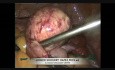Cistectomía de ovario por laparoscopia