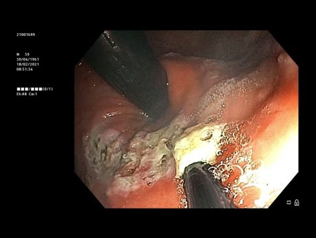 Ablación mucosa antirreflujo para ERGE