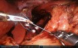 Cruroplastia robótica (hiatoplastia) y funduplicatura de Nissen para la ERGE y la hernia hiatal tipo 1