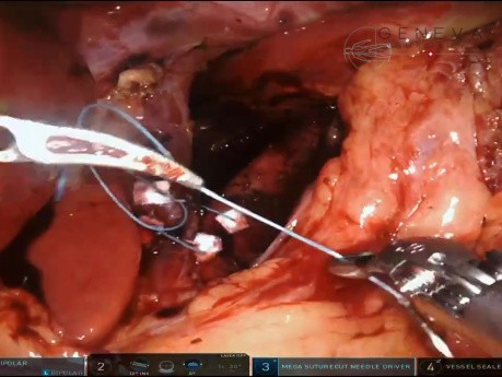 Cruroplastia robótica (hiatoplastia) y funduplicatura de Nissen para la ERGE y la hernia hiatal tipo 1