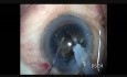 Capsulorrexia en catarata dura y manejo de ruptura de capsula posterior