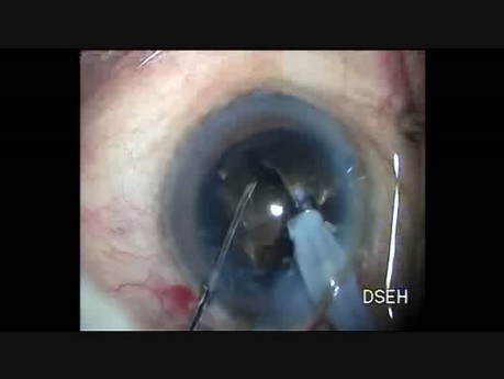 Capsulorrexia en catarata dura y manejo de ruptura de capsula posterior