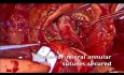 Reconstrucción de la continuidad aortomitral con parche de pericardio bovino y reemplazo de válvula mitral y aórtica