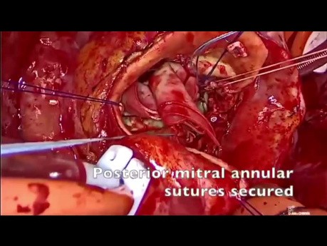 Reconstrucción de la continuidad aortomitral con parche de pericardio bovino y reemplazo de válvula mitral y aórtica