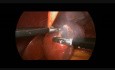 Destechamiento laparoscópico de quiste hepático en niño de 14 años
