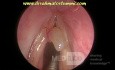 Pólipo vocal izquierdo