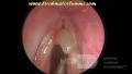 Pólipo vocal izquierdo