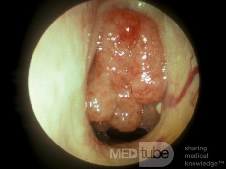 Adenoides agrandadas