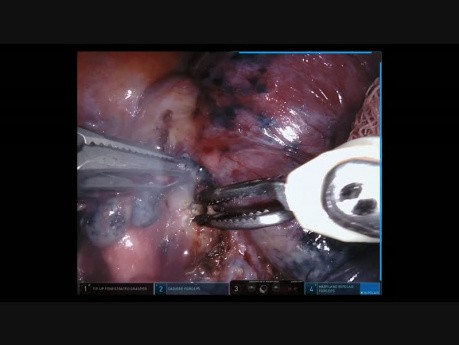 Lobectomía robótica del lóbulo inferior derecho 