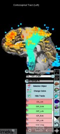 Planificación quirúrgica con neuronavegador en paciente con lesión de masa intracraneal. Glioma de alto grado.