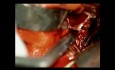 Malformación arteriovenosa MAV