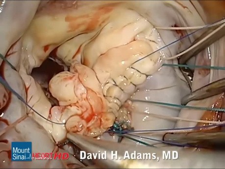 Reparación de la válvula mitral en la enfermedad de Barlow compleja