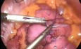 Anastomosis del intestino delgado - cirugía laparoscópica