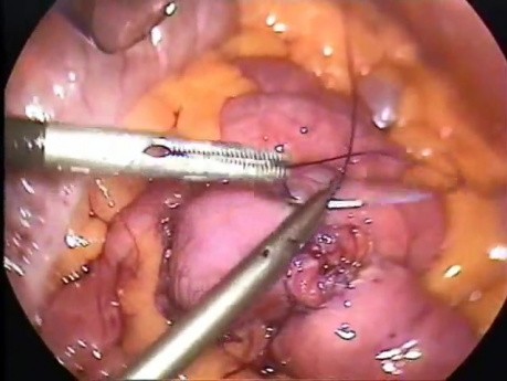 Anastomosis del intestino delgado - cirugía laparoscópica