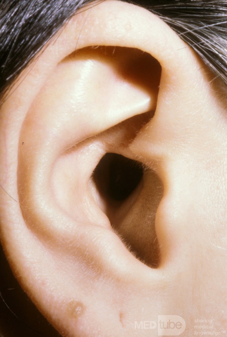 Cavidad mastoidea