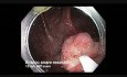 Colonoscopia: Resección en-bloc de una pólipo sésil y serrato 