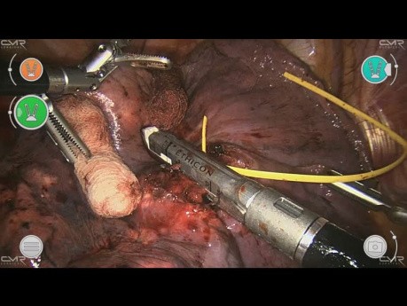 Lobectomía inferior derecha robótica CMR Versius