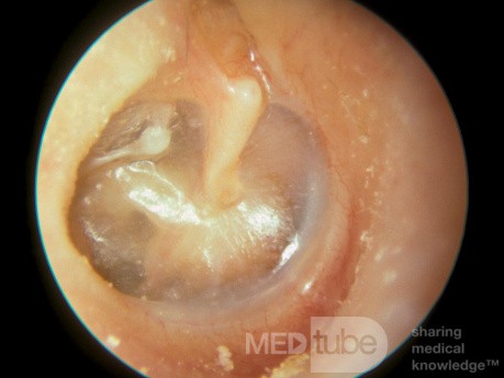 Miringoestapediopexia del oído derecho
