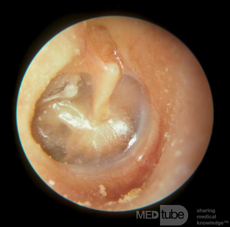 Miringoestapediopexia del oído derecho