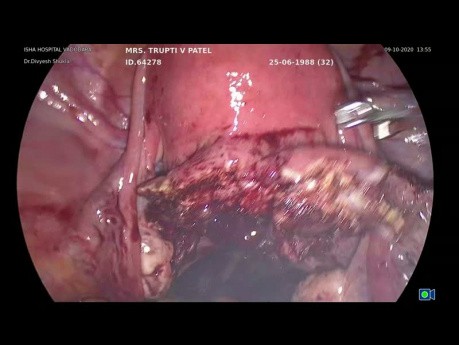 Miomectomía laparoscópica para fibroma cervical posterior