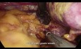 Gastrectomía total laparoscópica D2