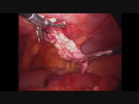 Tratamiento laparoscópico de la hernia de Richter
