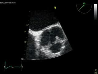 Insuficiencia valvular aórtica grave en enfermedades reumáticas