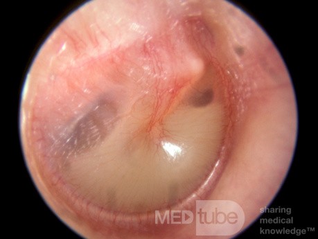 Resolución de otitis media mucoide [nivel hidroaéreo]