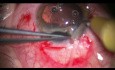 Cirugía plástica de iris postraumática sin necesidad de utilizar implantes de iris