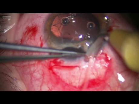 Cirugía plástica de iris postraumática sin necesidad de utilizar implantes de iris