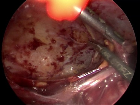 Abordaje laparoscópico de la diverticulitis de Meckel en un abdomen con cicatrices: un vídeo clínico.