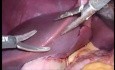 Abordaje laparoscópico biliar en donante de hígado vivo con dos venas porta y dos conductos biliares en el injerto del lóbulo derecho.
