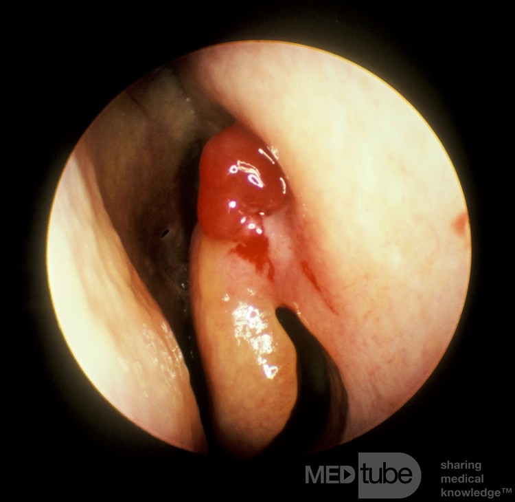 Hemangioma capilar