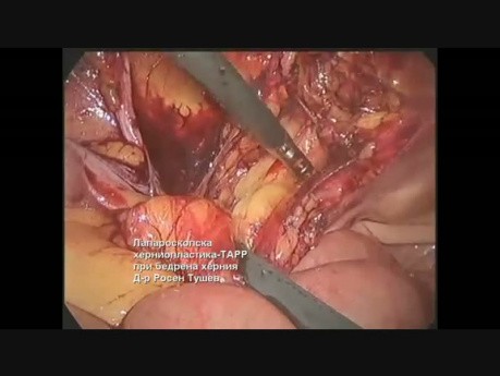 Reparación laparoscópica de hernia TAPP para hernia femoral izquierda