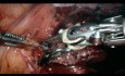 Resección de masa tumoral de la ventana aortopulmonar, cirugía asistida por robot