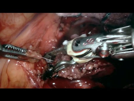Resección de masa tumoral de la ventana aortopulmonar, cirugía asistida por robot