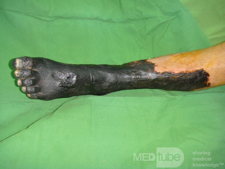 Gangrena seca miembro inferior izquierdo en paciente diabético
