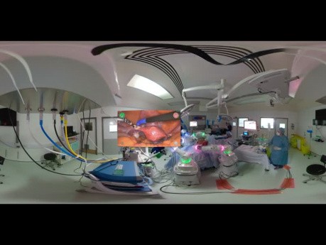 Histerectomía con Versius en 360° en el Milton Keynes University Hospital