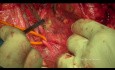 Cirugía citorreductora del cáncer de ovario. La exenteración pélvica posterior modificada.