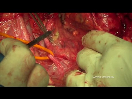 Cirugía citorreductora del cáncer de ovario. La exenteración pélvica posterior modificada.