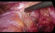 Cáncer de Recto Recurrente - TME laparoscópica