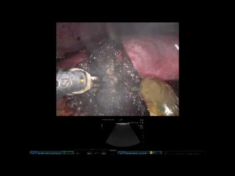 Resección robótica de carcinoma hepatocelular del segmento VI en un hígado cirrótico con maniobra intracorpórea de Pringle
