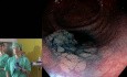 Disección submucosa endoscópica (DSE) de adenoma rectal - prof. Yutaka Saito