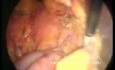 Hernia paraduodenal izquierda - tratamiento laparoscópico