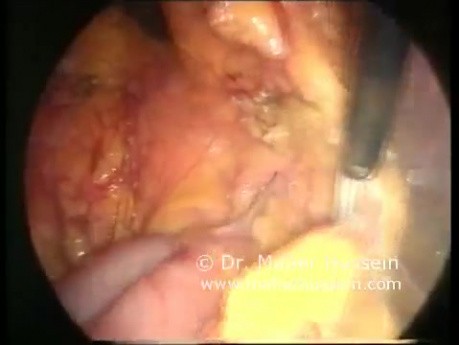Hernia paraduodenal izquierda - tratamiento laparoscópico
