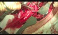 Desconexión quirúrgica de fístula traqueoesofágica