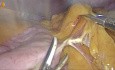 Gastrectomía sleeve laparoscópica: guía paso a paso