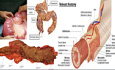 Tumores del Colon