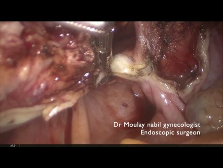 Histerectomía total laparoscópica con bisturí de Chardonnens