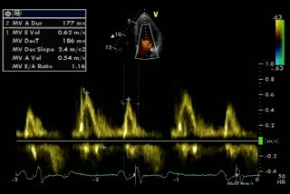 Flujo mitral pseudonormal - Valsalva - Disfunción diastólica etapa 2